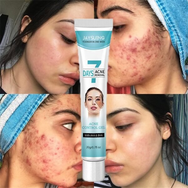 Crema tratamiento acne mascarilla facial FK23B-39 - Imagen 4